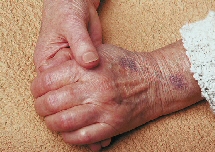 Algunos medicamentos para tratar la artritis aumentan riesgo de contraer herpes