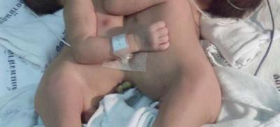 Siamesas nacidas en Hospital Barros Luco de Chile no podrán ser separadas