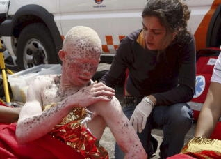 Un inmigrante albino pide asilo en Canarias porque en Africa "se lo querían comer para la buena suerte"