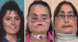 En Estados Unidos, una mujer con trasplante de cara muestra su rostro