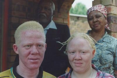 Tanzania: 12 a juicio por asesinar albinos y vender partes de sus cuerpos para brujería
