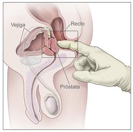 Colombia: Lo iban a operar de la próstata, pero le extirparon un testículo