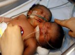 Nace niña con dos cabezas en Filipinas