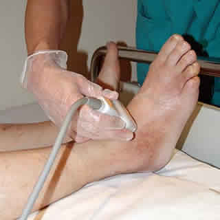 Muchas amputaciones de pie por diabetes podrían evitarse