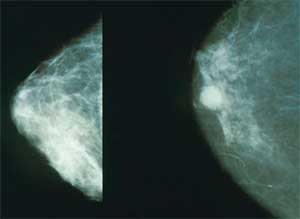 Descubren nueva vía para atajar las metástasis óseas del cáncer de mama
