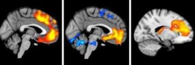 Investigadores españoles detectan zona cerebral donde se localiza la esquizofrenia