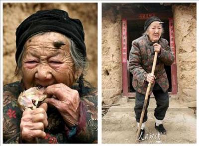 A una anciana china de 101 años le crece un cuerno negro de seis centímetros
