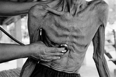 Tuberculosis resistente a fármaco causó 150.000 muertes en 2008: informa la OMS