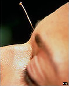 La acupuntura puede propagar infecciones