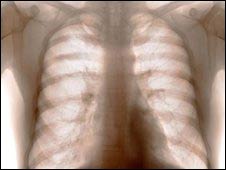 "Revolución" en el diagnóstico de cáncer de pulmón