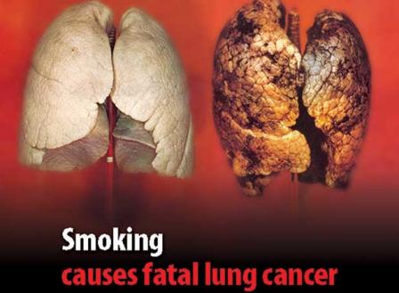 Una joven británica murió tras recibir pulmones de donante fumador