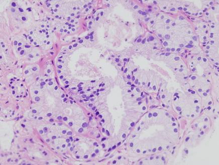 Identifican el origen celular del cáncer de próstata