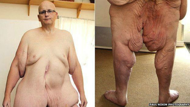 El hombre más gordo del mundo se quitó 25 kilos de piel
