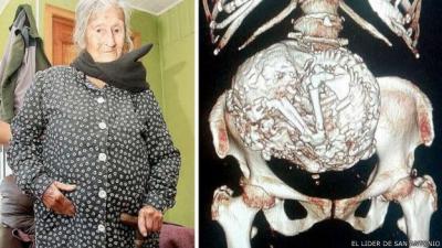 Anciana chilena carga un feto momificado en su vientre desde hace más de 60 años