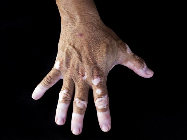Nuevo láser da esperanza a pacientes que sufren de vitiligo