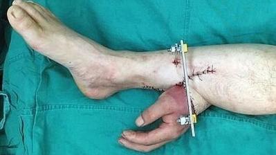 Salvan la mano de un hombre tras coserla a su pierna durante un mes