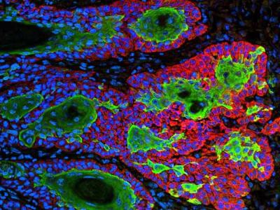 Crean nanopartículas para atacar los tumores