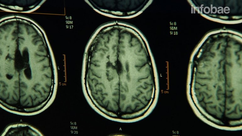 Cuáles son las áreas del cerebro que afecta el estrés