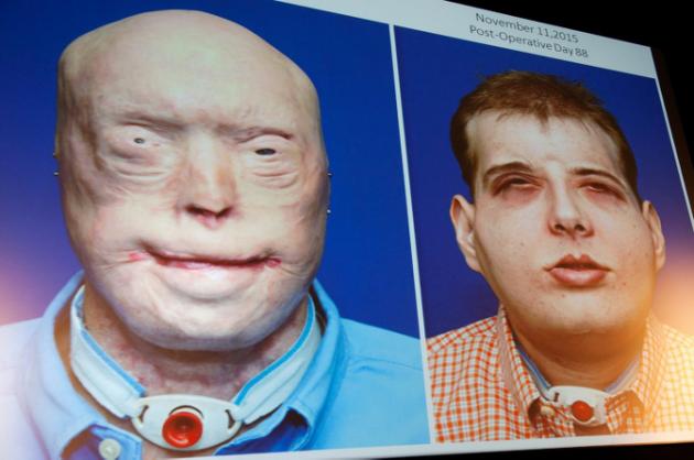 Practican el más complejo trasplante de rostro hasta ahora en Nueva York