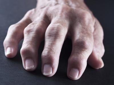 Descubren espectacular forma de tratar la artritis en un solo día