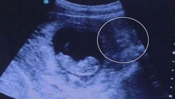 Extraña ecografía muestra una figura demoniaca 'vigilando' a un feto