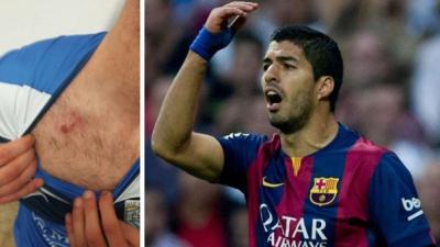 Jugadores de la Tercera División de España imitan a Luis Suárez mordiendo a sus rivales