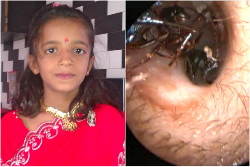 Descubren un hormiguero dentro del oído de una niña india