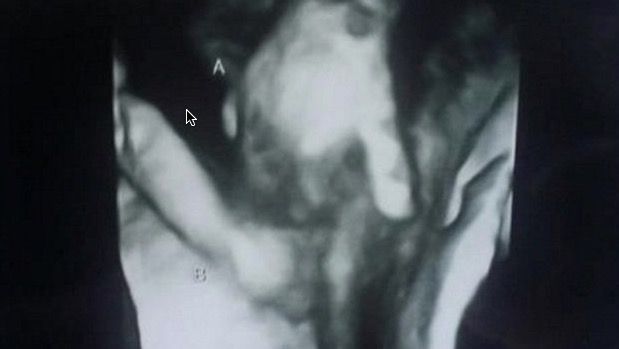 Bebé moribundo agarrando la mano de su hermanita gemela en útero de la madre
