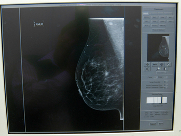 Diseñan dispositivo que detecta cáncer de mama a través de saliva