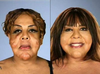 Esta mujer vivió 10 años con cemento en la cara: así quedó luego de que se lo quitaron