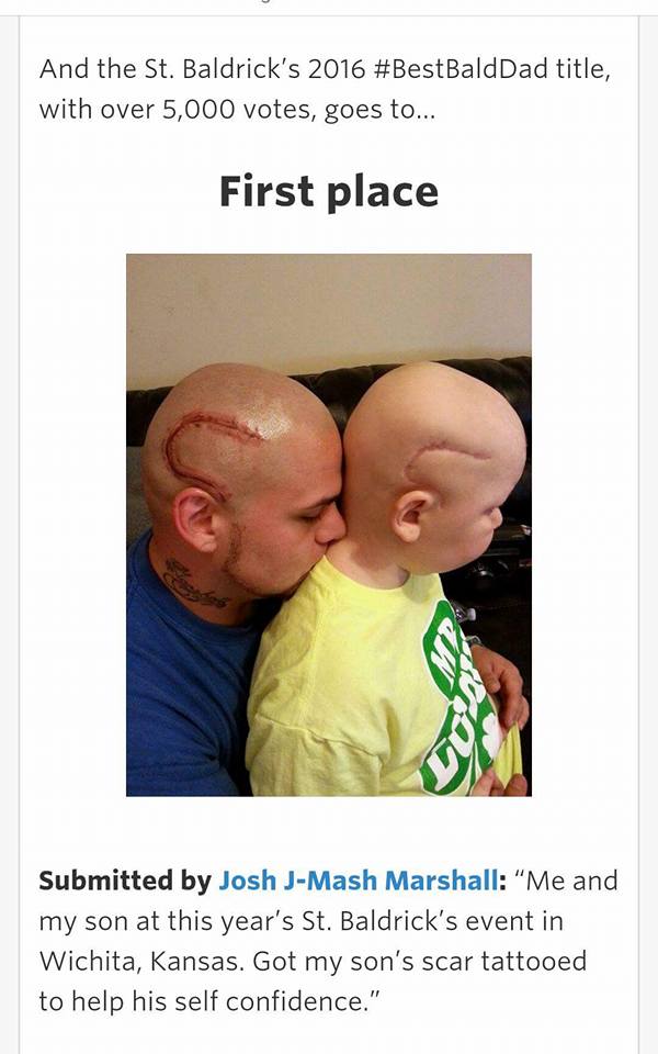 Un padre se tatúa en la cabeza la cicatriz de su hijo para que no "se sienta como un monstruo"