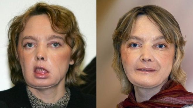 Muere Isabelle Dinoire, la paciente que fue sometida al primer trasplante de cara del mundo